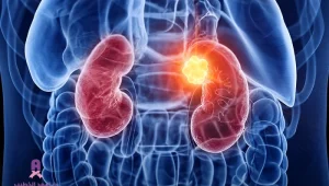 جراحة أورام الكلى