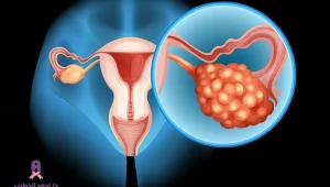 جراحة أورام المبايض