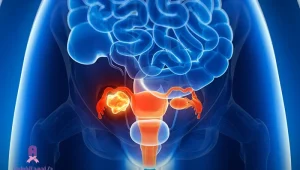 علاج أورام المثانة