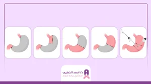 تكلفة عملية استئصال المعدة