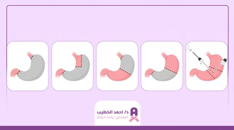 تكلفة عملية استئصال المعدة