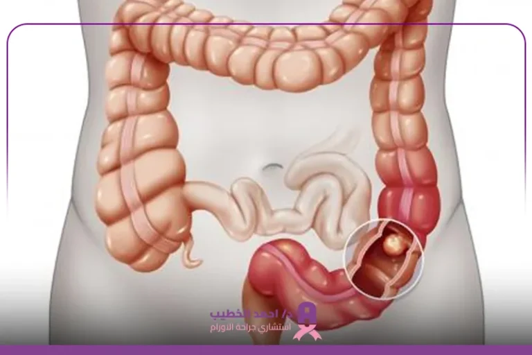 عملية استئصال سرطان المستقيم