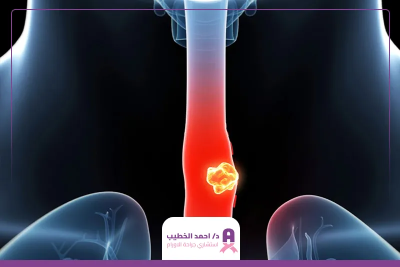 نسبة الشفاء من سرطان المريء