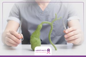 عملية استئصال المرارة