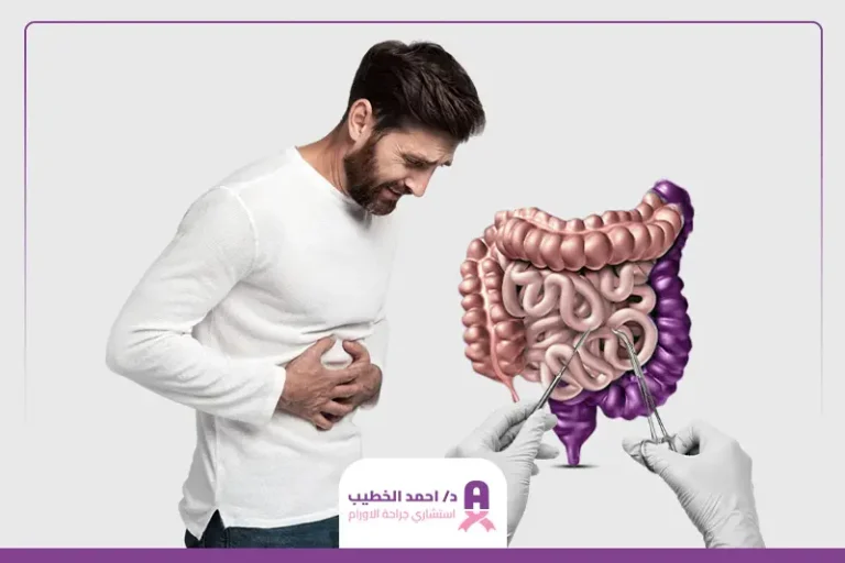 تجربتي مع استئصال جزء من القولون