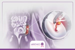 أنواع أورام القولون