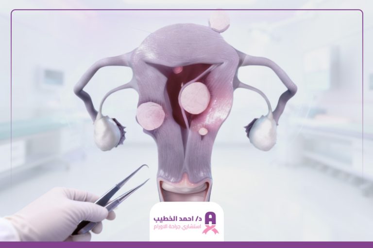 جراحة الأورام الليفية في الرحم