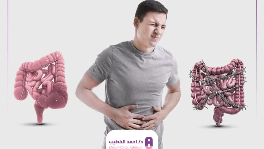 الفرق بين أعراض سرطان القولون والقولون العصبي