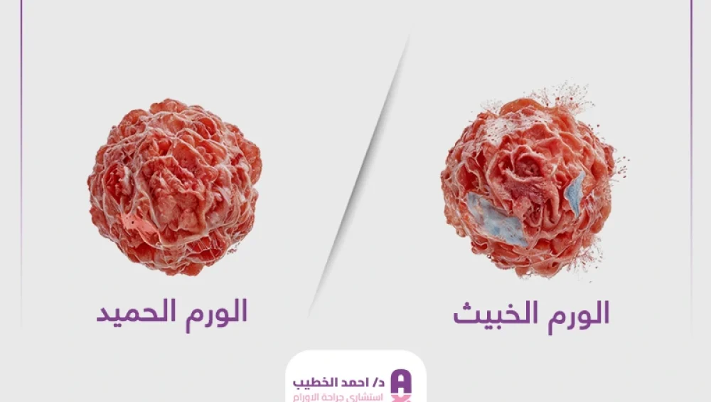 الفرق بين الورم الحميد والورم الخبيث الفرق بين الورم الحميد والورم الخبيث في الثدي