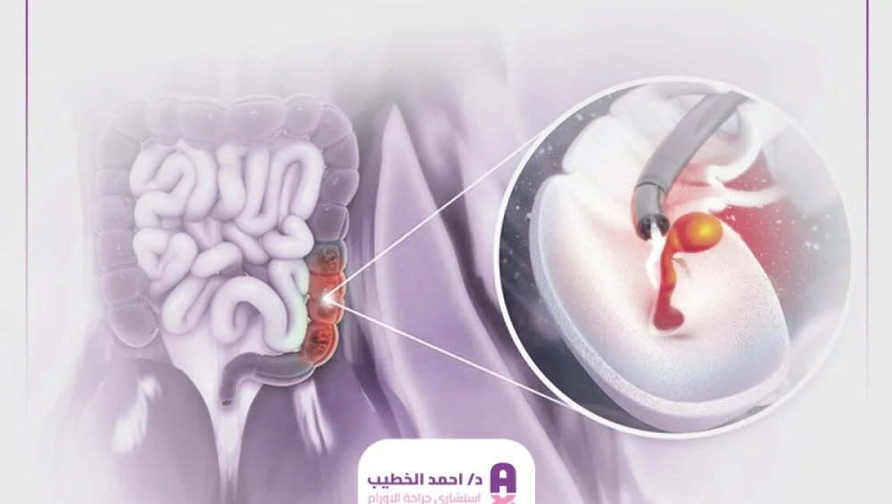 أنواع أورام القولون