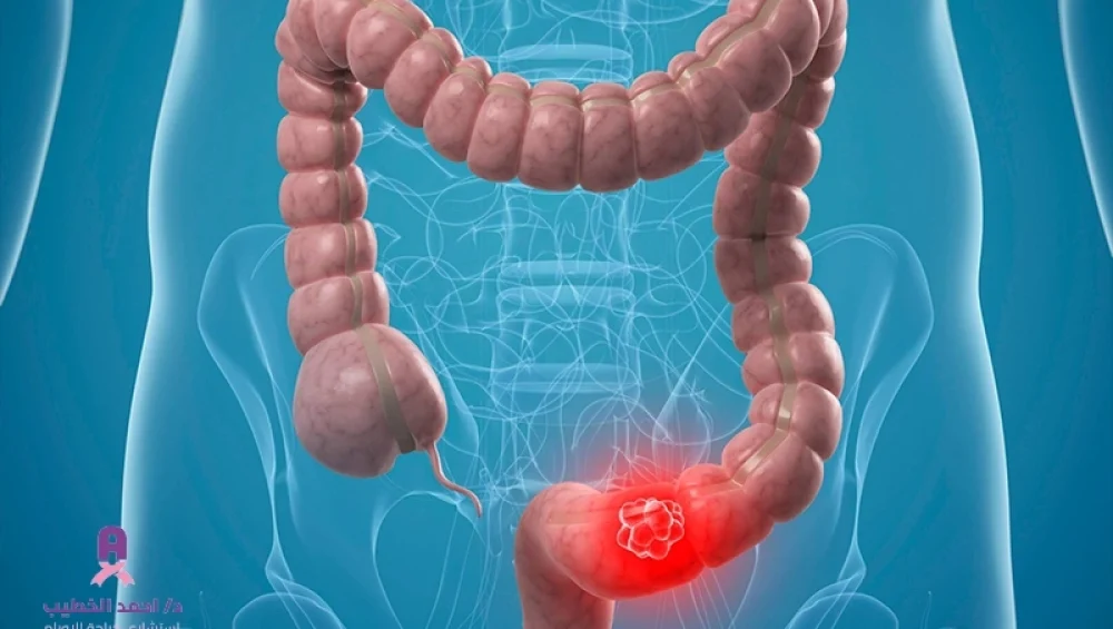 اورام القولون والمستقيم (1)