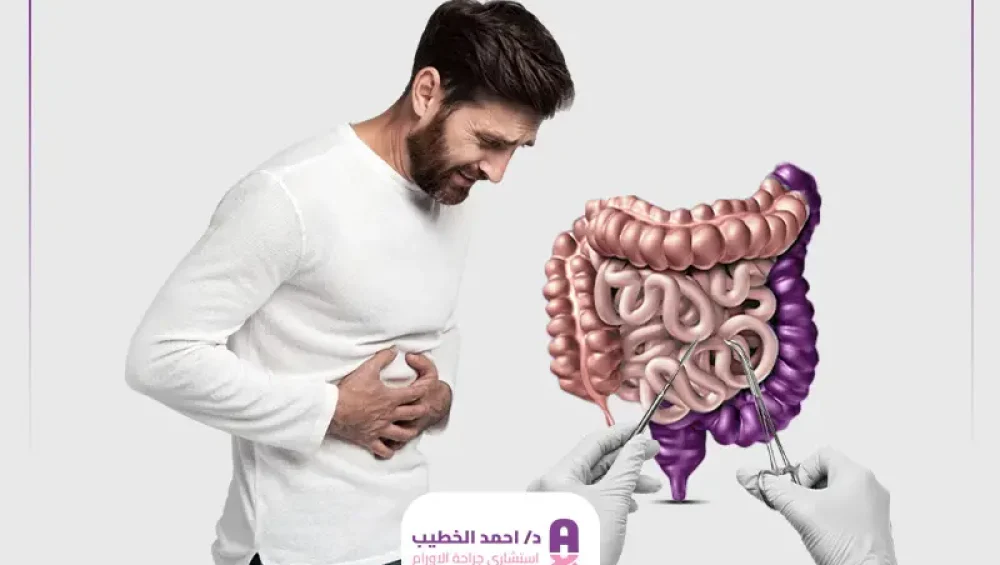 تجربتي مع استئصال جزء من القولون