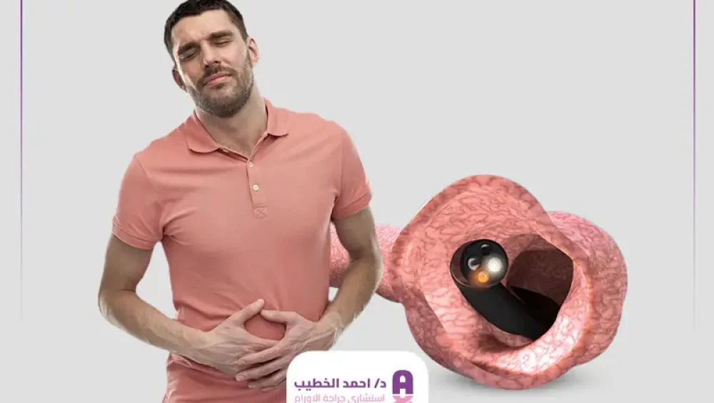 تجربتي-مع-منظار-القولون تجربتي مع منظار القولون