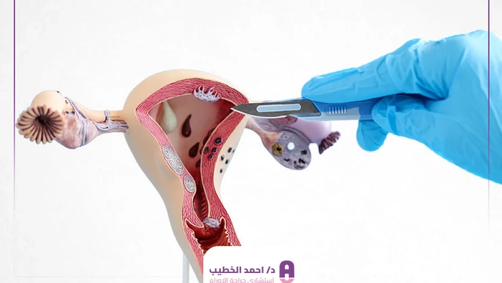 تكلفة عملية استئصال الرحم بالمنظار