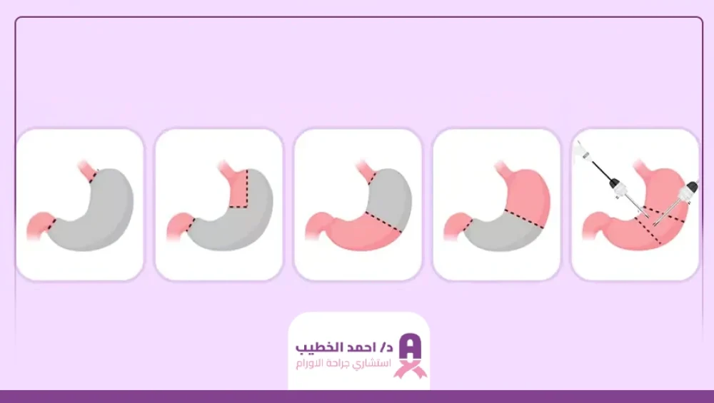 تكلفة عملية استئصال المعدة