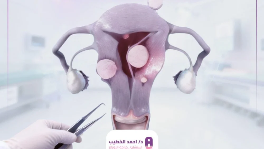 جراحة الأورام الليفية في الرحم