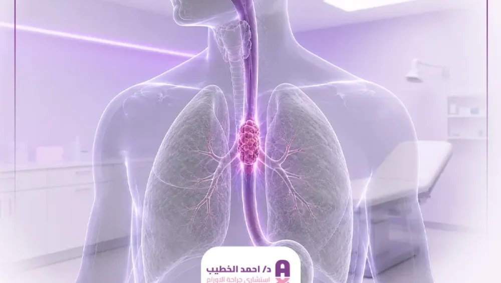 سرطان المريء