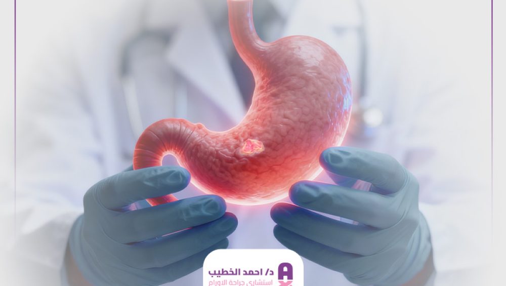 علاج أورام المعدة 