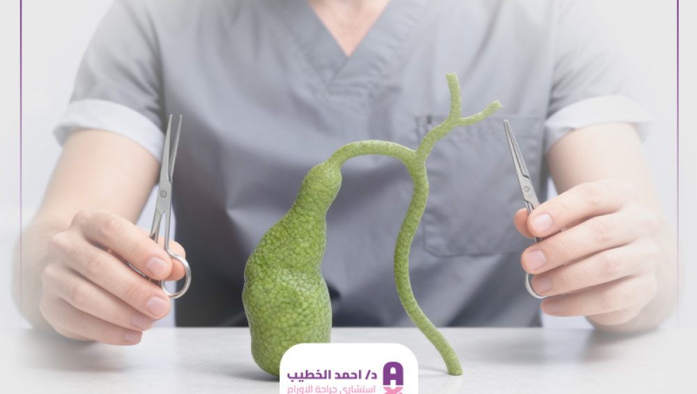 عملية استئصال المرارة