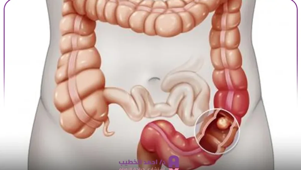 عملية استئصال سرطان المستقيم