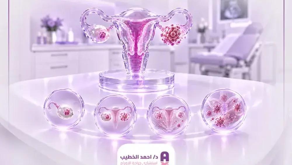 مراحل سرطان المبيض