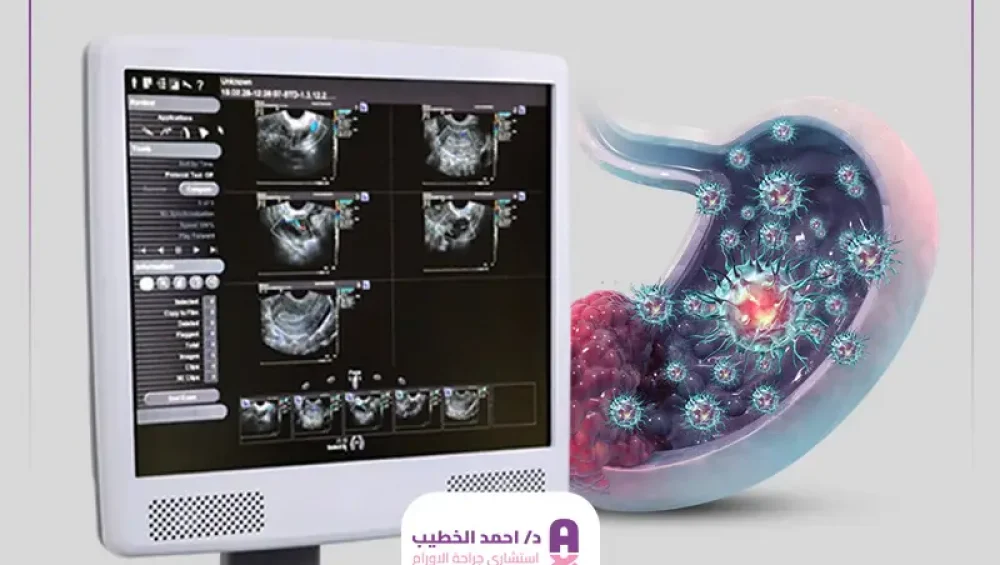 هل السونار يكشف سرطان المعدة