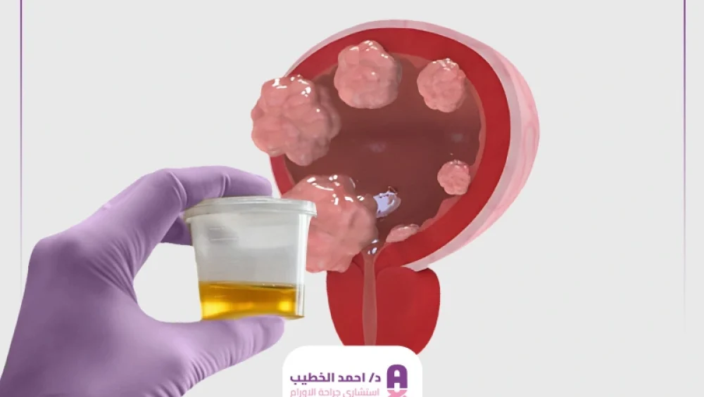 هل تحليل البول يكشف سرطان المثانة